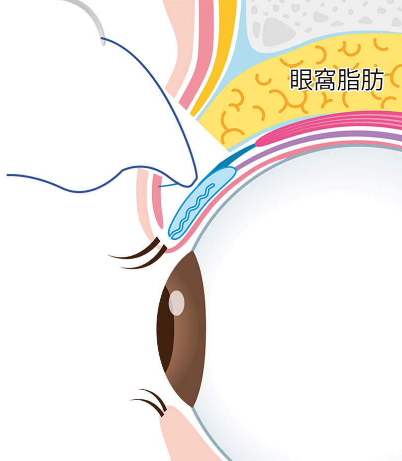 05,癒着のための固定の説明画像