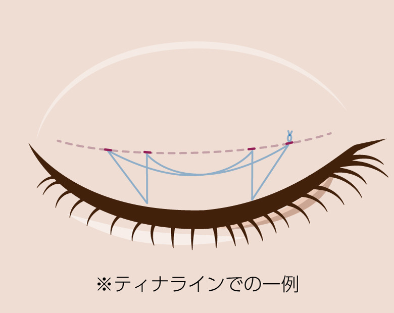 二重埋没法イラスト