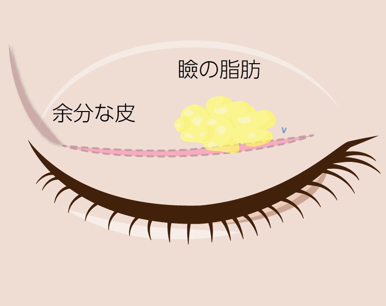 二重整形切開法イラスト