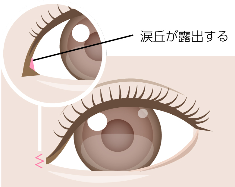 目頭切開イラスト