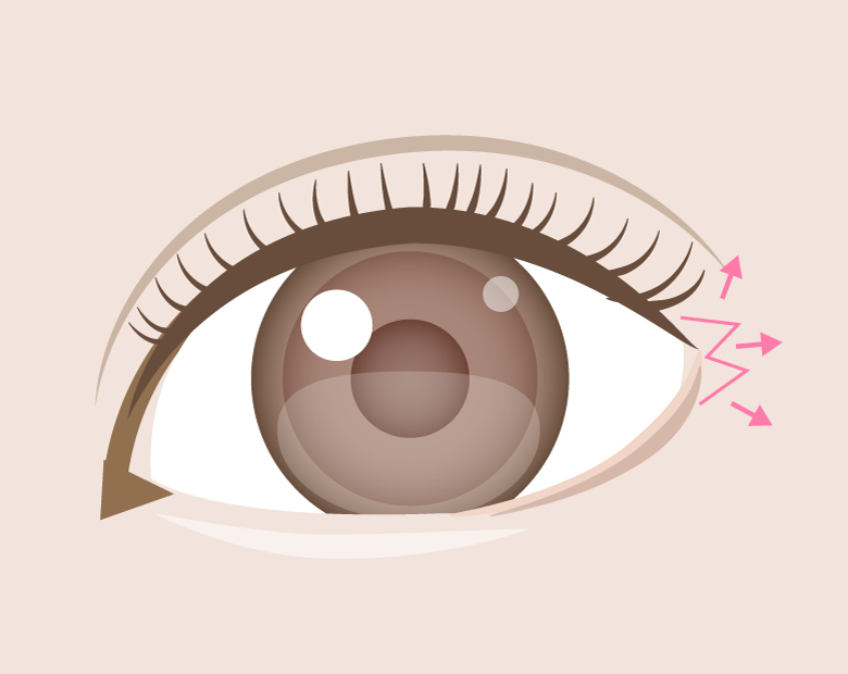 目尻切開イラスト