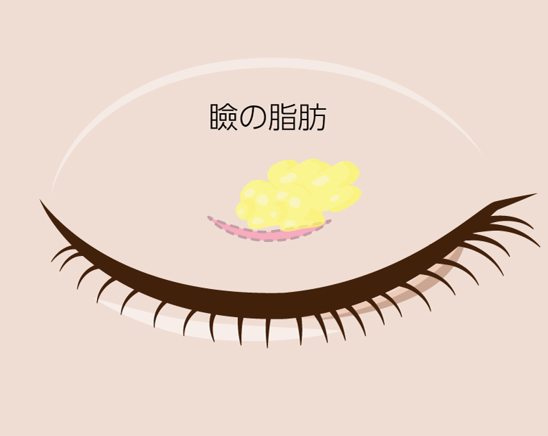 まぶたの脂肪取りイラスト