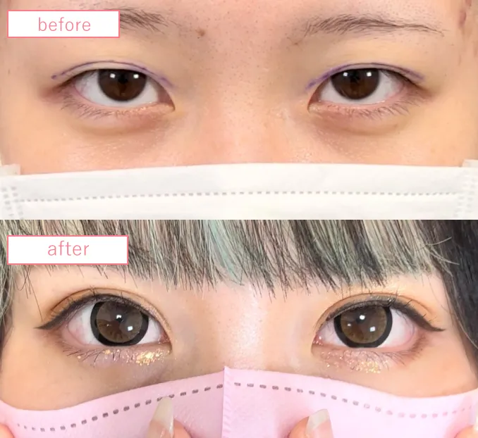 埋没法複合施術でのグラマラスラインイメージ