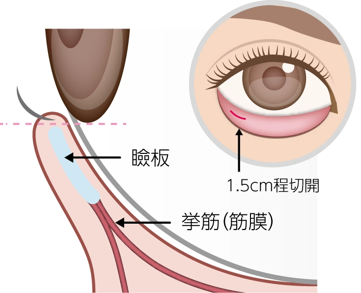 グラマラスライン埋没法説明イメージ01