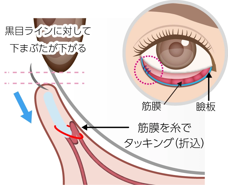 グラマラスライン埋没法説明イメージ02