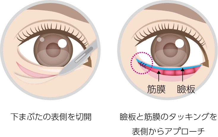 グラマラスライン切開法説明イメージ01