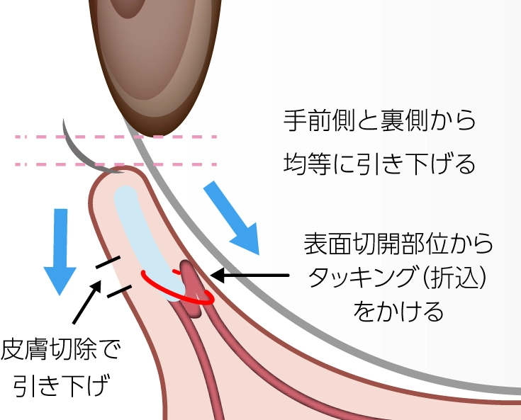 グラマラスライン切開法説明イメージ02