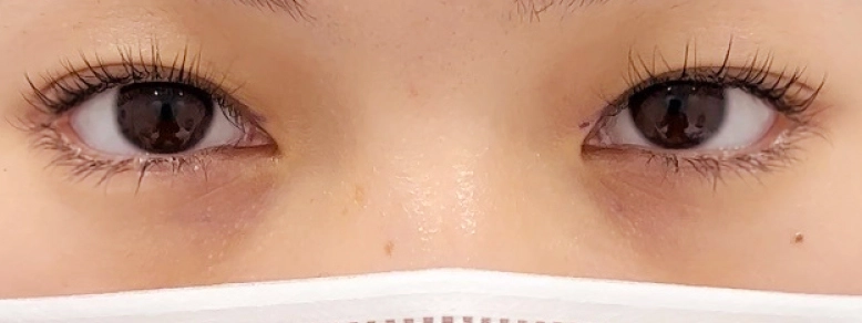 無くなってしまったヒアルロン酸涙袋