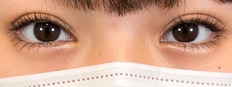 涙袋ヒアルロン酸再充填修正