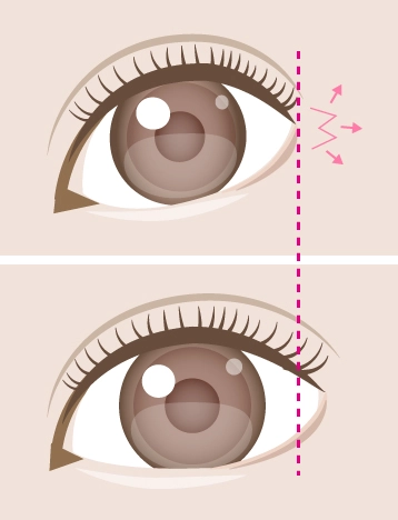 目尻切開イメージ