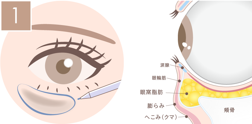裏ハムラ法の施術方法01