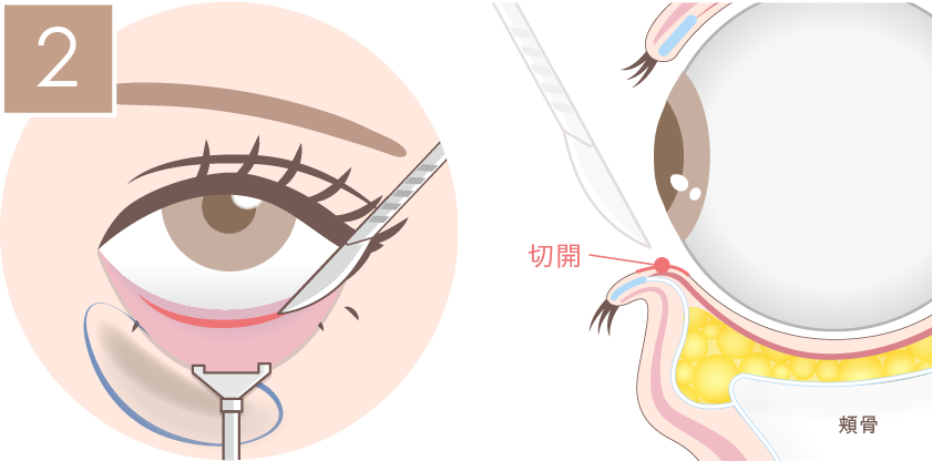 裏ハムラ法の施術方法02