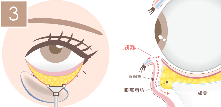 裏ハムラ法の施術方法03