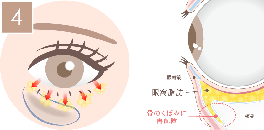 裏ハムラ法の施術方法04