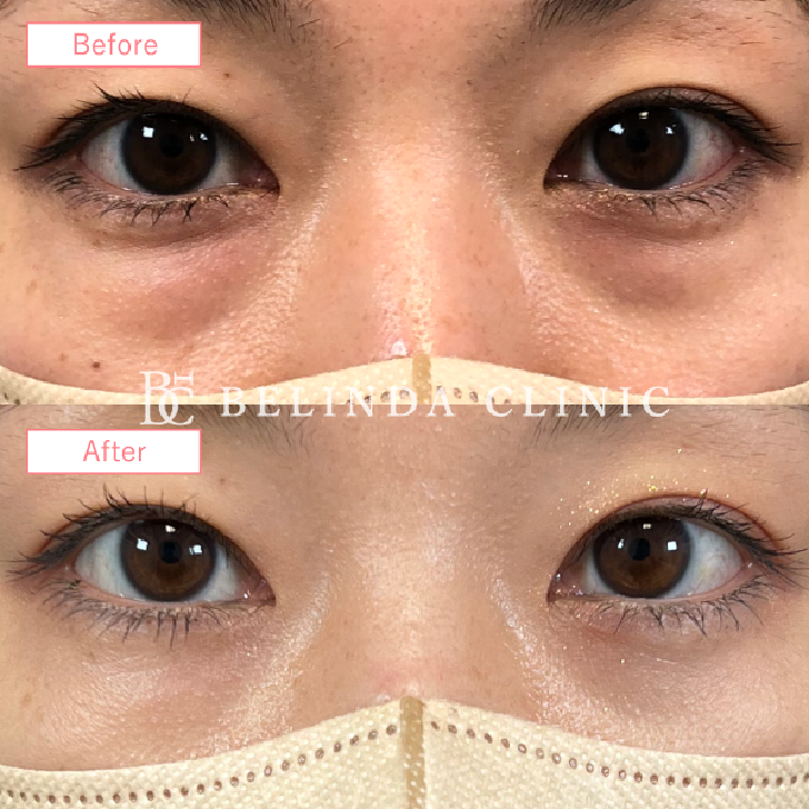 岡山院切らないクマ取り経結膜脱脂術症例