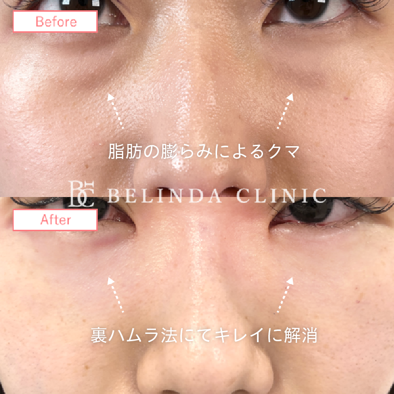 裏ハムラ症例画像