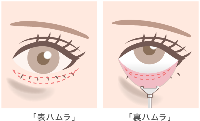 表ハムラ・裏ハムラ法説明