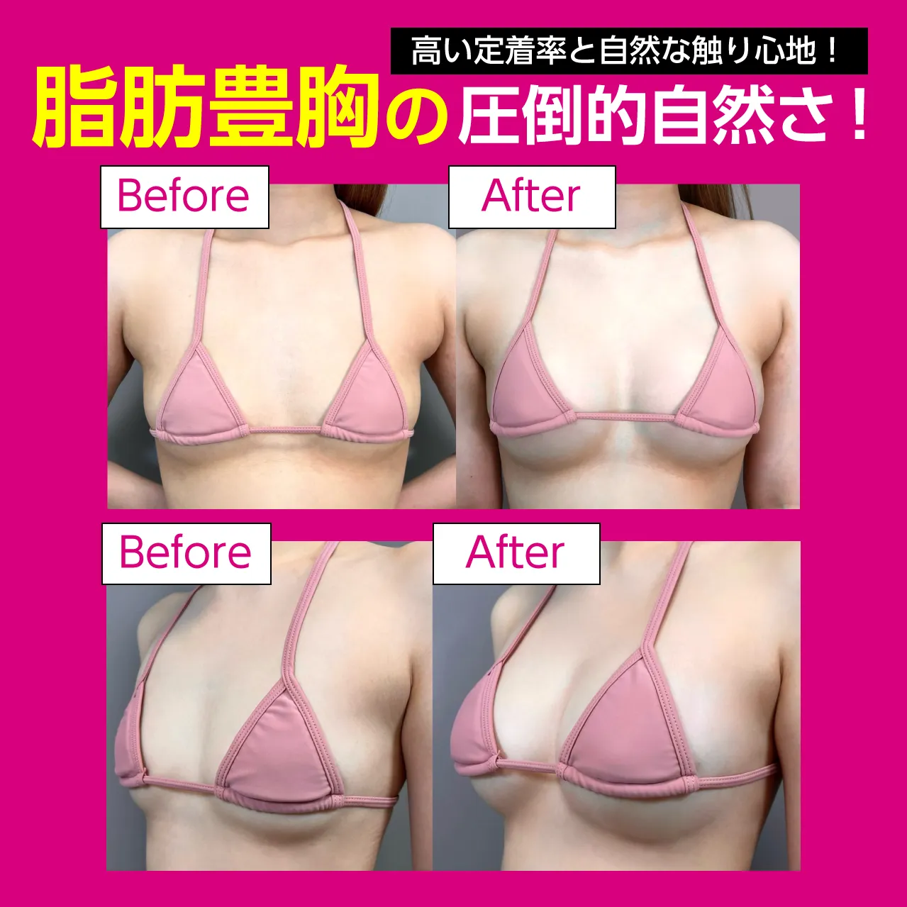 脂肪注入豊胸症例広告