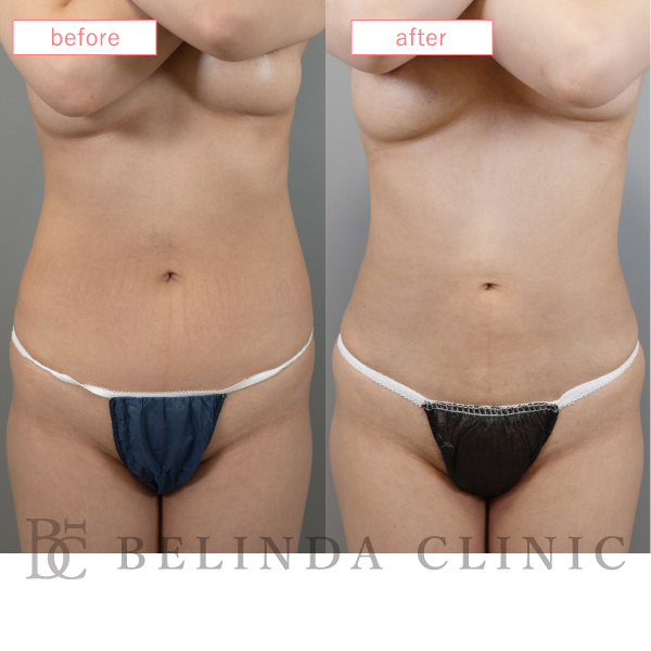 腹部脂肪吸引症例