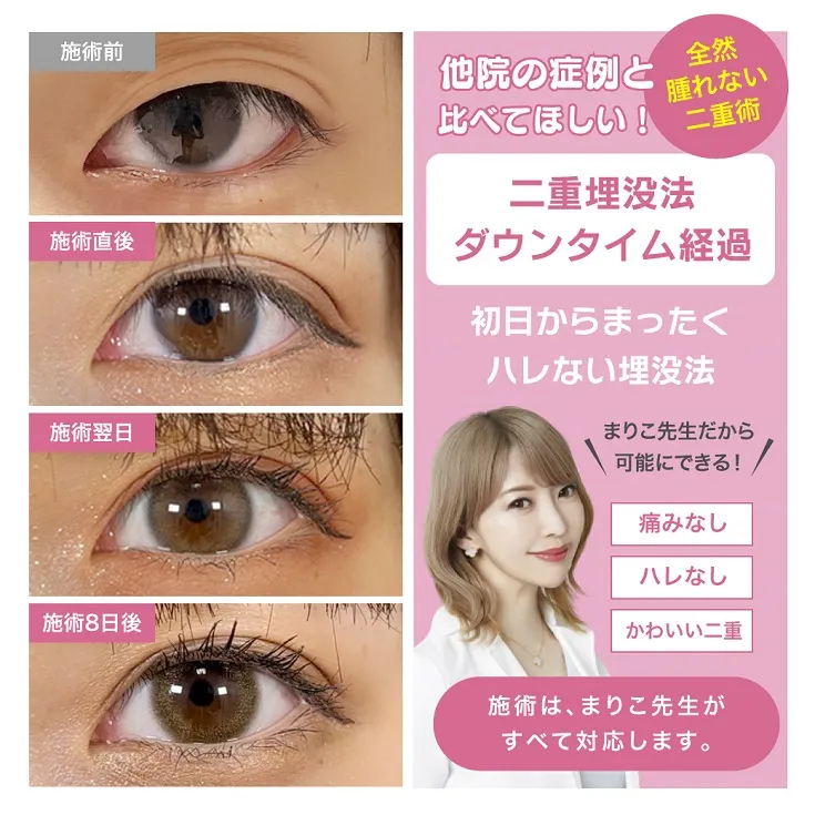 腫れない埋没法バナー