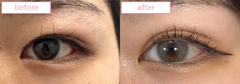 埋没法の末広型を平行型へ修正画像