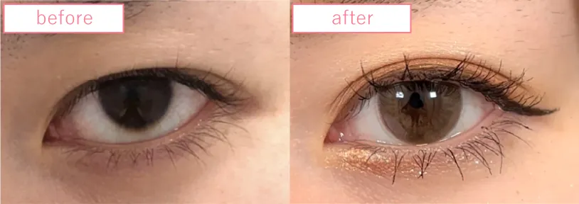 崩れてしまった埋没法の修正画像