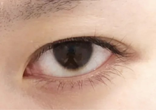 二重形状崩れ画像