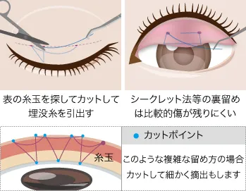 糸玉側から抜糸アプローチをかけて引き抜きます。複雑な縫い目や糸が組織に食い込んでる場合は細かくカットして数回にて引き抜きます。
