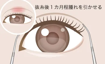 抜糸後1カ月程腫れ・腫れが引いてから二重のデザイン画像