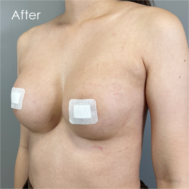 ハイブリッド豊胸アフター
