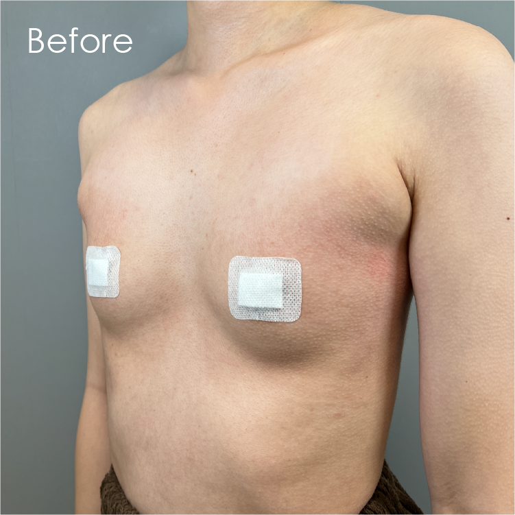 ハイブリッド豊胸ビフォア