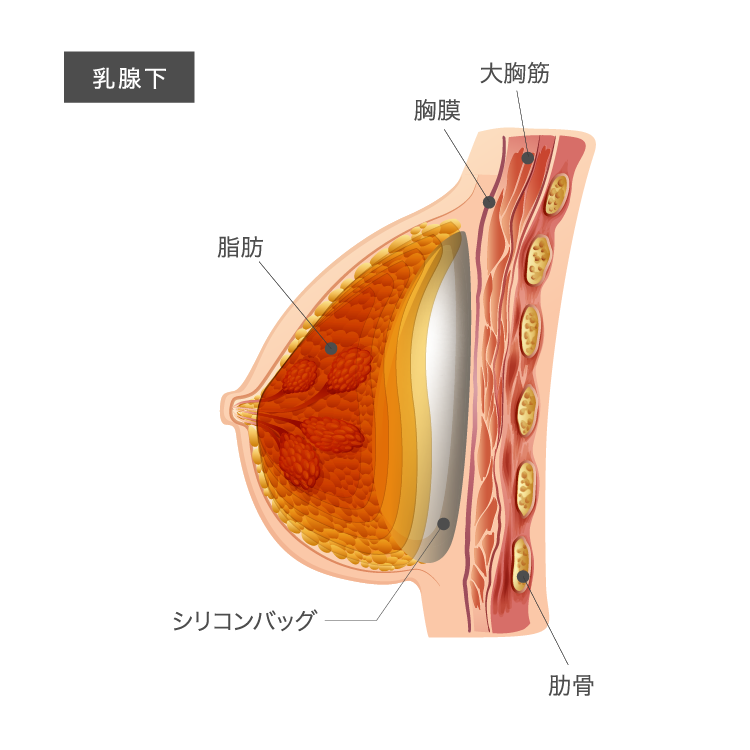 ハイブリッド豊胸のバッグ位置:乳腺下イメージ