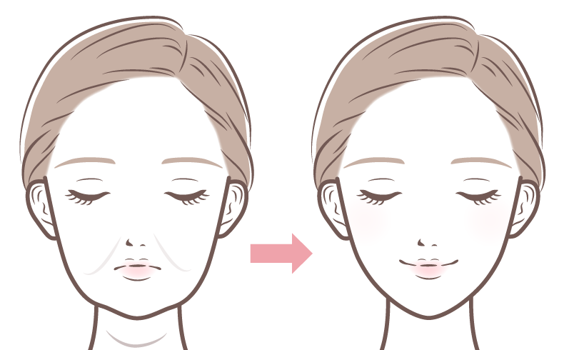 糸リフトイメージ