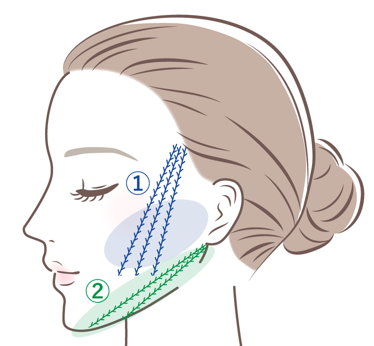 糸リフトの挿入部位イメージ01