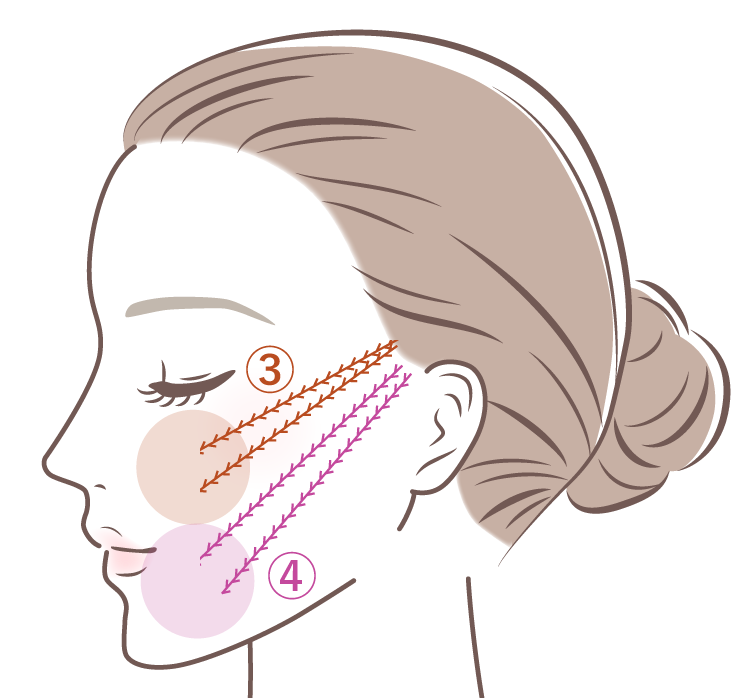 糸リフトの挿入部位イメージ02