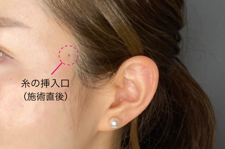 糸リフト施術直後傷口