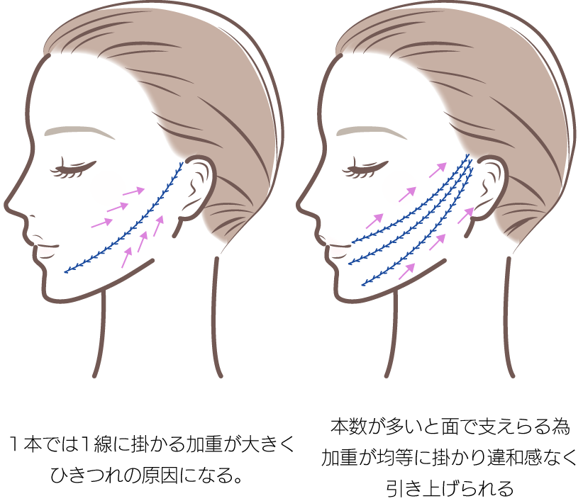 糸リフト本数イメージ
