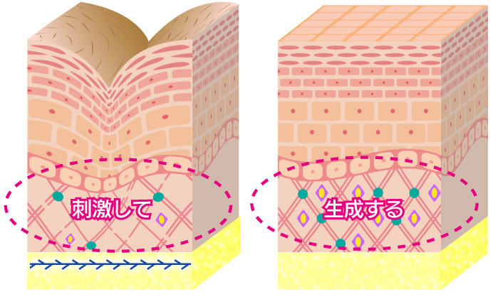 糸リフトコラーゲン生成イメージ