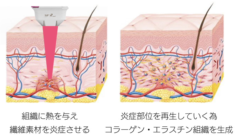HIFUコラーゲン生成イメージ