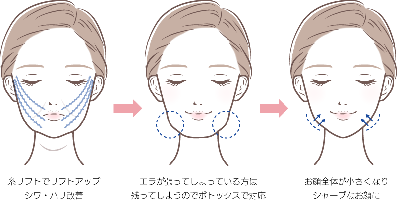 糸リフト・ボツラックスコンビネーション施術