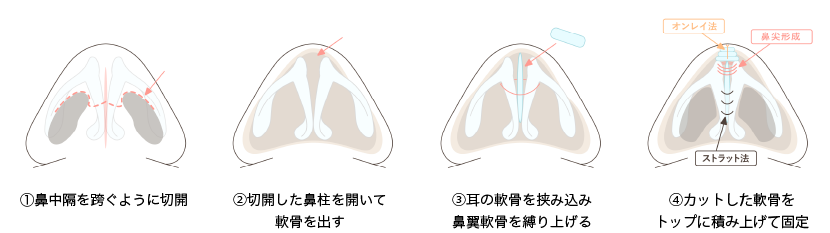 鼻尖形成・耳介軟骨移植施術方法イラスト