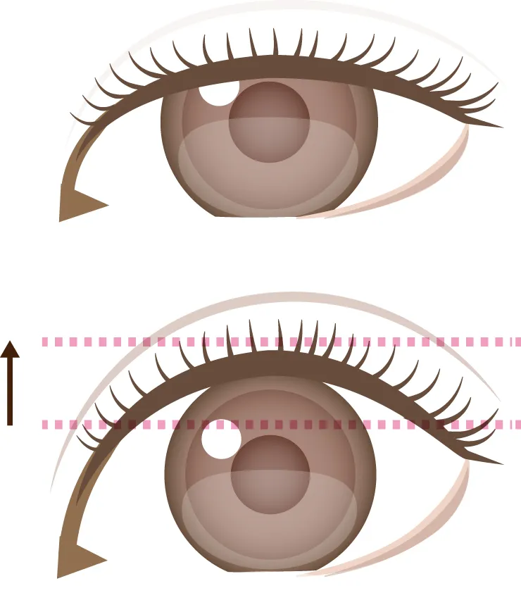 切らない眼瞼下垂イメージ