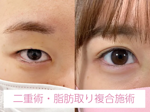 まぶたの引き上げだけでなく二重術やまぶたの脂肪除去等の美容施術がMIX可能