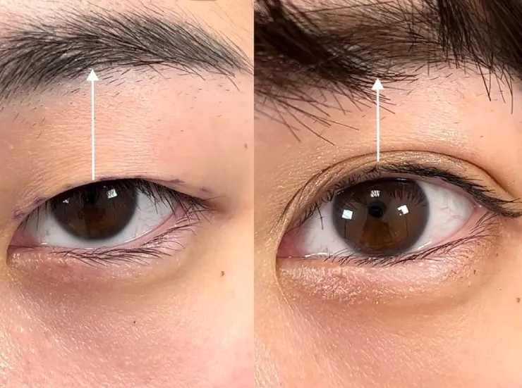 機能障害の適用ではない審美的なまぶたが重い症状でも適用可