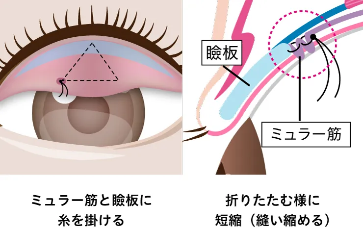 眼瞼下垂施術方法イメージ
