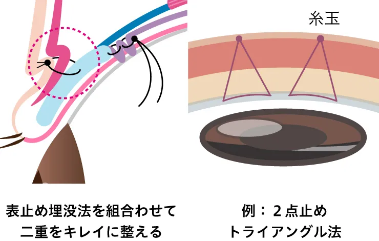 眼瞼下垂瞼板イメージ