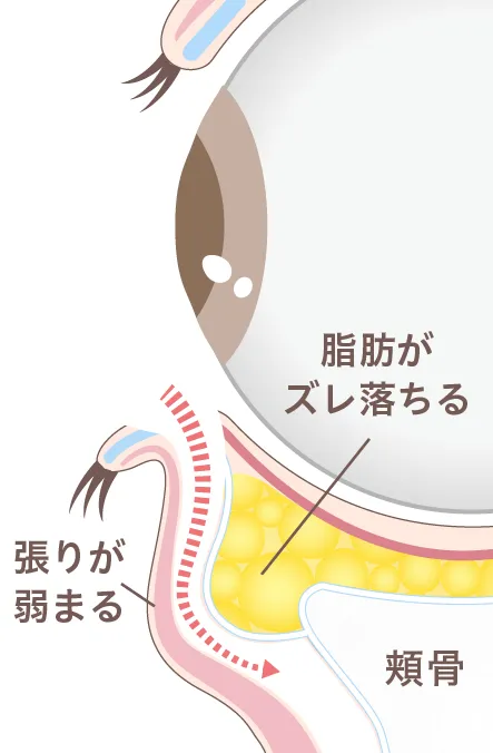 眼窩脂肪イメージ02