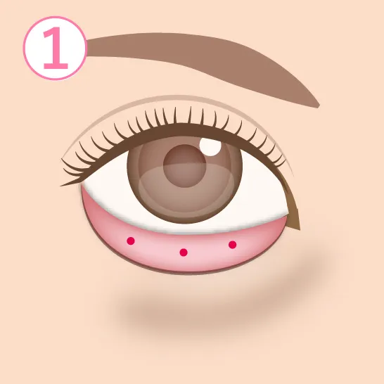 眼窩脂肪除去イメージ02