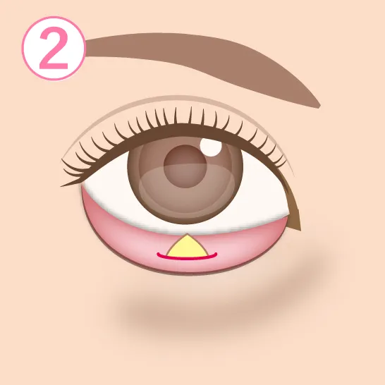 眼窩脂肪除去イメージ02