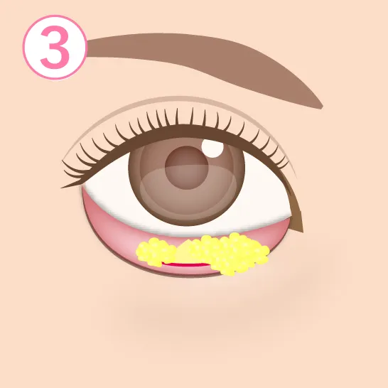 眼窩脂肪除去イメージ03